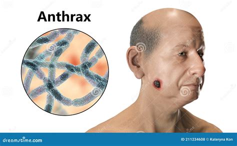 Cutaneous Anthrax, the Most Common Form of Anthrax Stock Illustration ...