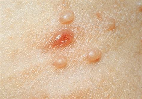 Molluscum Contagiosum - Pictures, Symptoms, Treatment, Causes - HubPages