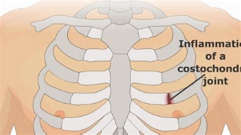 Costochondritis Cuasesymptoms Diagnosis Treatment Physiotherapy ...