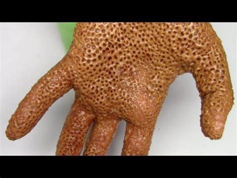 Trypophobia Skin Disease Hand