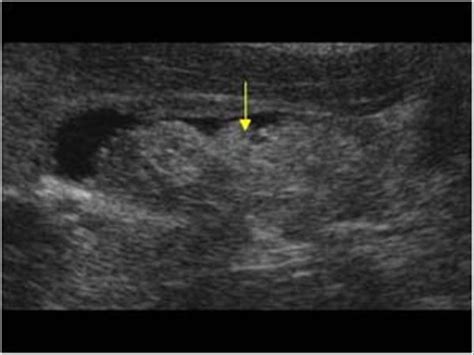 Abdomen and retroperitoneum | 1.2 Gallbladder and bile ducts : Case 1.2 ...