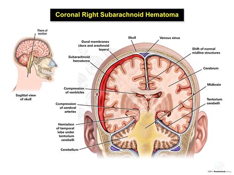 Coronal Right Subarachnoid Hematoma