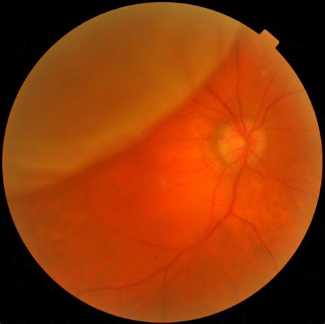 Retinal Detachment in Children - Eye Specialist, Treatments