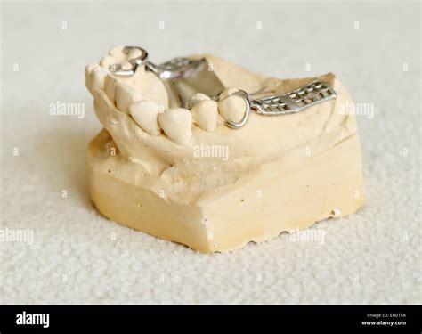 Dental metal framework for partial denture on cast model Stock Photo ...