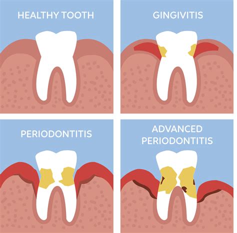 Learn the Core Causes of Gingivitis and How Your Dentist Can Help You ...