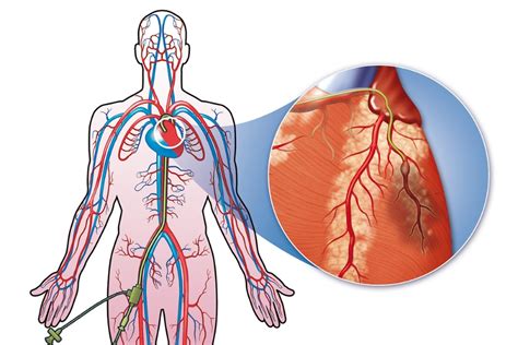 Cardiac Catheterization - What Is Cardiac Catheterization | NHLBI, NIH