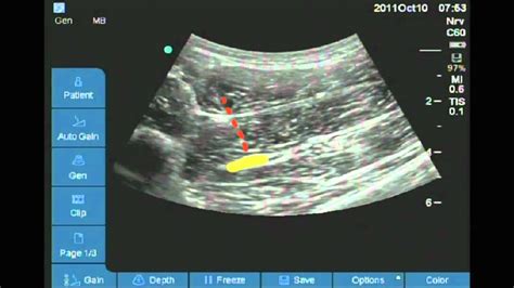 Sciatic Nerve Block Landmarks : Figure 2 from Ultrasound-guided sciatic ...