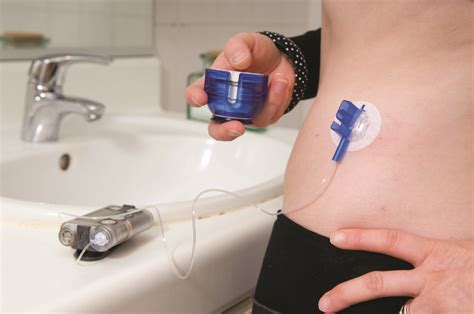 Insulin pumps lead to better clinical outcomes compared with injection ...