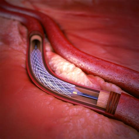 coronary artery stent 3d max