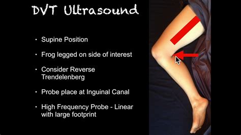 Blood Clot In Leg Ultrasound