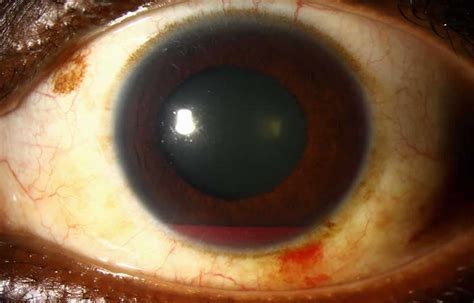 Hyphema causes, symptoms, grading, complications, recovery & treatment