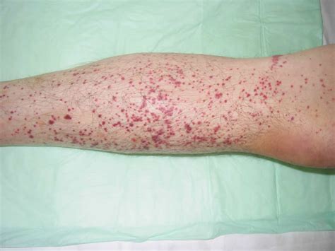 Thrombocytopenia - Causes, Signs, Symptoms, Diagnosis, Treatment