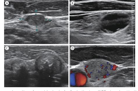 [PDF] Ultrasonographic Findings of Cervical Lymph Nodes | Semantic Scholar