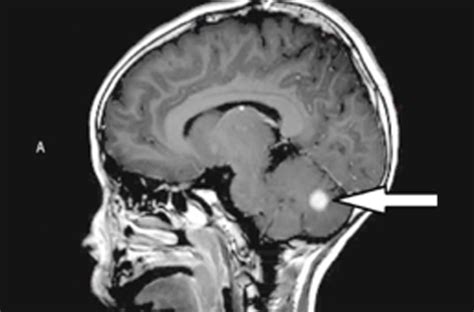 Juvenile Pilocytic Astrocytoma