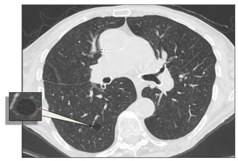 Cystic Bullous Disease Of The Lung - Captions Trend