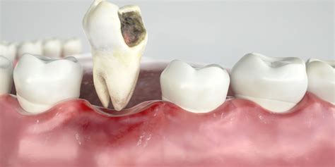 Tooth Extraction Services in Seven Fields & Oakdale, PA