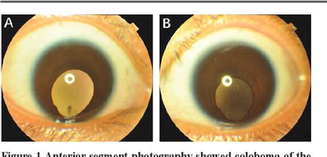 Figure 1 from Bilateral congenital uveal coloboma concurrent with ...