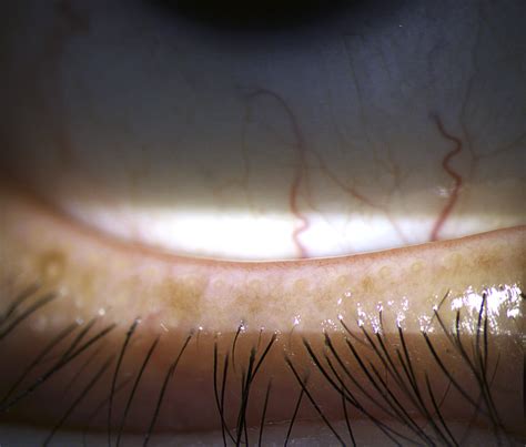 Intraductal meibomian gland probing and its efficacy in the treatment ...