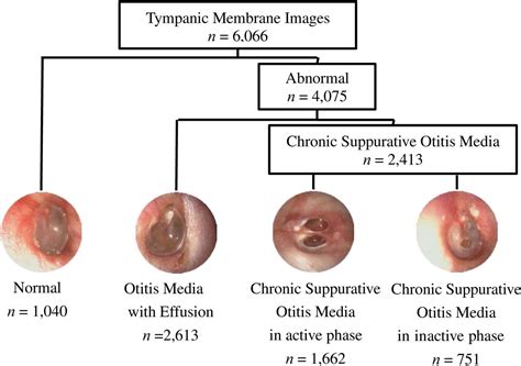 Tympanic Membrane Otitis Media