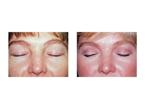 Upper Blepharoplasty and Eyelid Scars - Explore Plastic Surgery