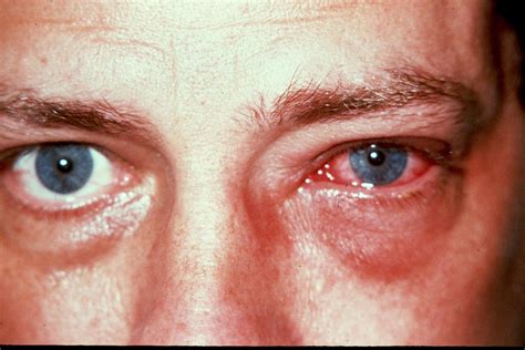 Eye infections, bacterial; Bacterial Eye Infections; Ocular Infections ...