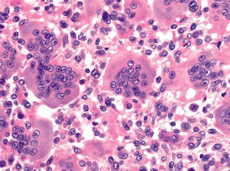 Pathology Outlines - Giant cell tumor of bone