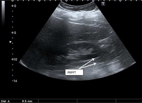 Abdominal ultrasound of 58 years old female patient showing: A. The ...