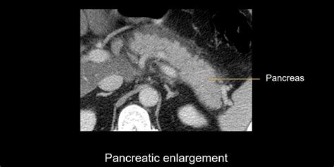 Abdominal CT: interstitial pancreatitis • LITFL • Radiology Library