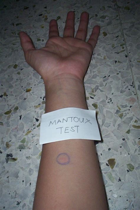 Between the Lines: MANTOUX Test