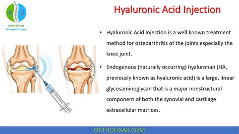 Hyaluronic Acid Injections: How Do They Treat Arthritis?, 43% OFF