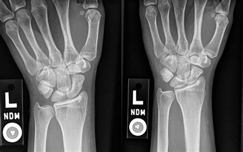 Fracture of the Capitate | Journal of Orthopaedic & Sports Physical Therapy