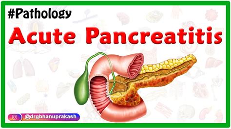 Acute Pancreatitis: Etiology , signs and Symptoms, pathophysiology ...