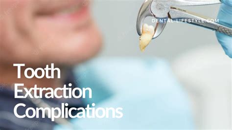 Tooth Extraction Complications | oral health | dental-lifestyle