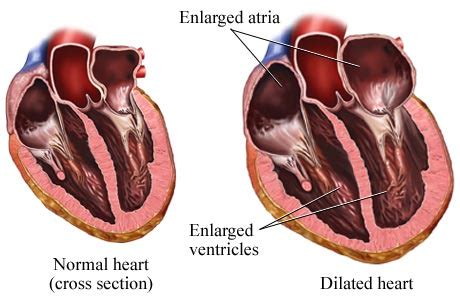 Hypertensive Heart Disease – Symptoms, Treatment, Causes