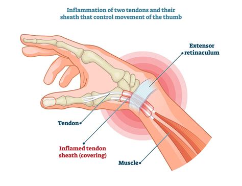 De Quervain's Tenosynovitis | Complete Physio