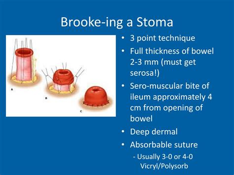 PPT - The Difficult Stoma PowerPoint Presentation - ID:257323