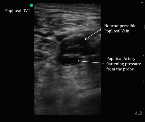 Blood Clot In Leg Ultrasound