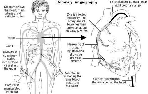 Coronary Angiography. Medical investigation into angina | Patient