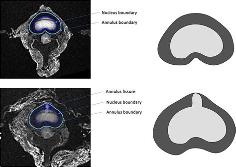 Nucleus Pulposus Mri