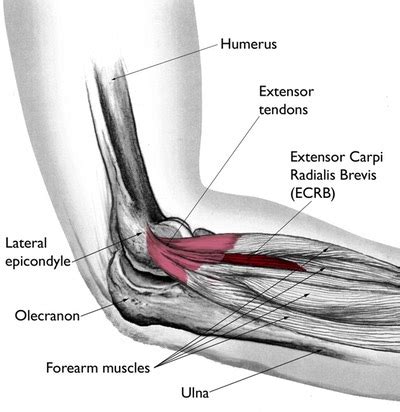 Tennis Elbow and Elbow Tendinopathies | Orthopedic Regenerative ...