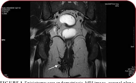 Figure 1 from Episiotomy Scar Endometriosis. Case Presentation ...