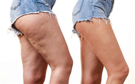 What Causes Cellulite and How to Get Rid of It Fast - Health Tenfold