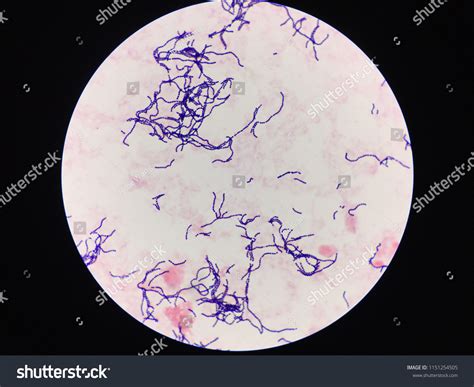 Streptococcus Pyogenes Infected Aged Patient Showing Stock Photo ...