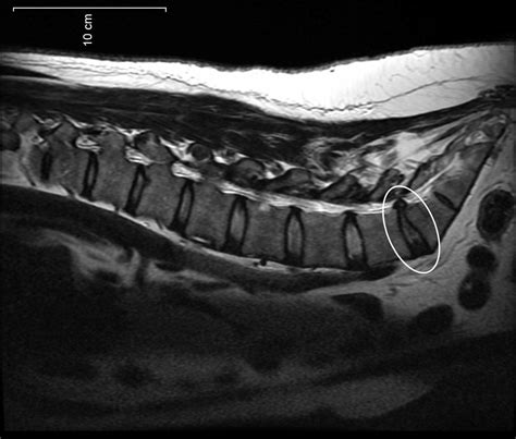 File:Spinal-disc-protrusion-l5.jpg - Wikimedia Commons