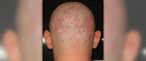 Prevention of seborrheic dermatitis | Skin & Hair problems articles ...