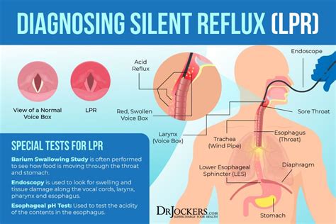 Silent reflux symptoms causes and support strategies – Artofit