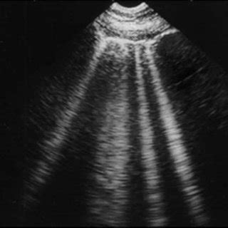 (PDF) A-Lines and B-Lines Lung Ultrasound as a Bedside Tool for ...