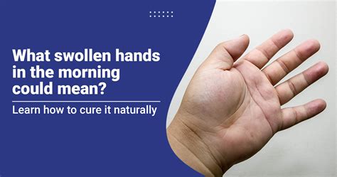 What Swollen Hands in the Morning Could Mean?