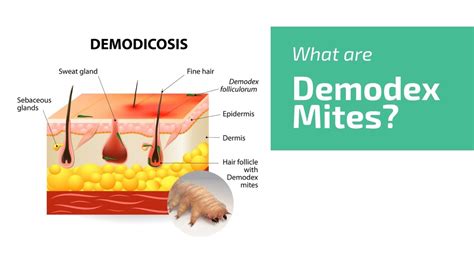 What Are Demodex Mites? Face Mite, Hair Mite | UNGEX - YouTube