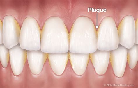 #HealthFeature: How To Protect Your Teeth From Dental Plaque ...